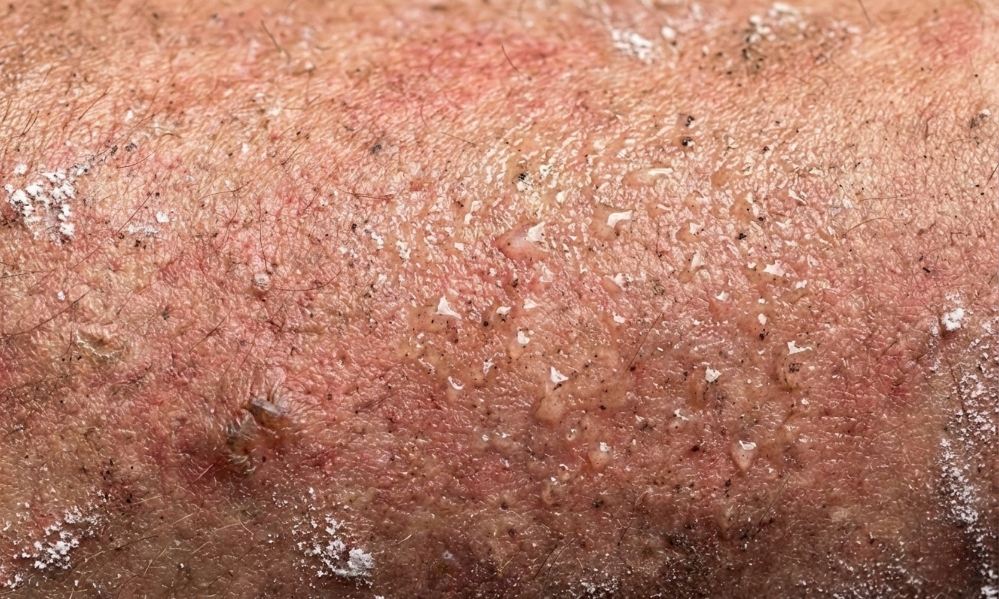 Nahaufnahme gereizter Haut mit Schweiß und Rückständen. Vorher-Zustand: Typische Belastung der Hautbarriere (Mattenbrand) nach dem BJJ und Grappling Training.